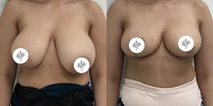 This is one of our beautiful breast asymmetry correction patient 2