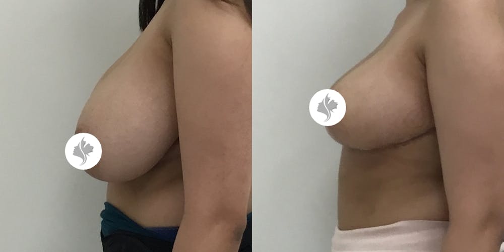 This is one of our beautiful breast asymmetry correction patient #2