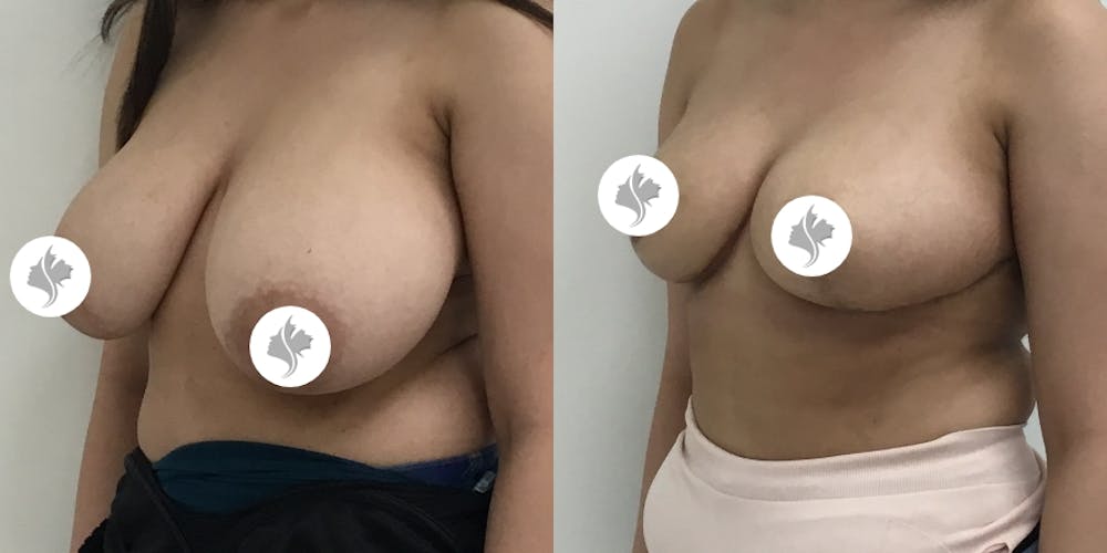 This is one of our beautiful breast asymmetry correction patient #2