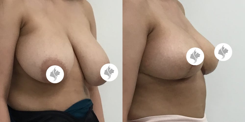 This is one of our beautiful breast asymmetry correction patient #2