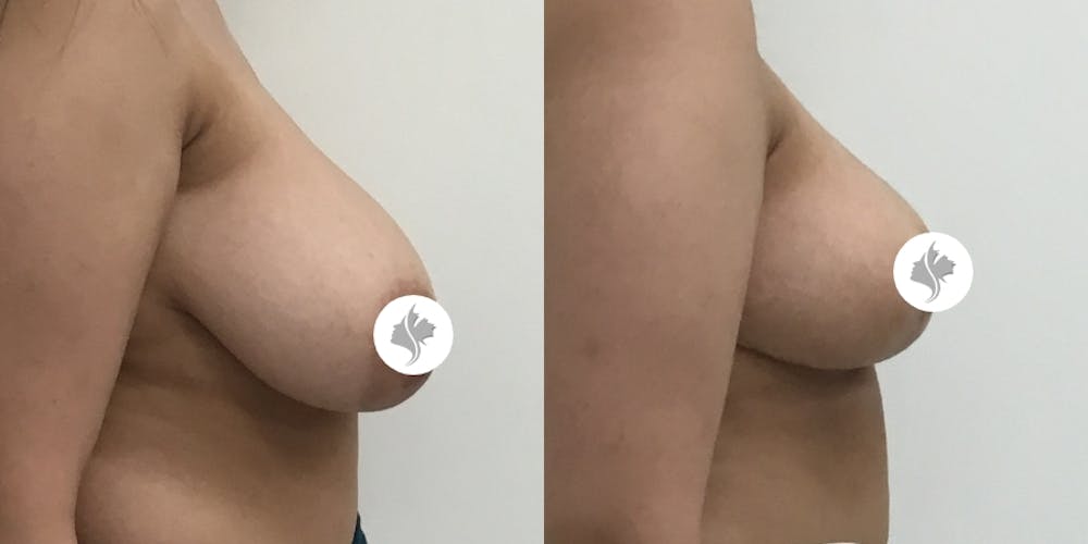 This is one of our beautiful breast asymmetry correction patient #2