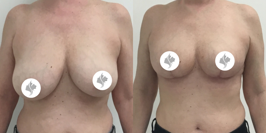 This is one of our beautiful breast asymmetry correction patient 13