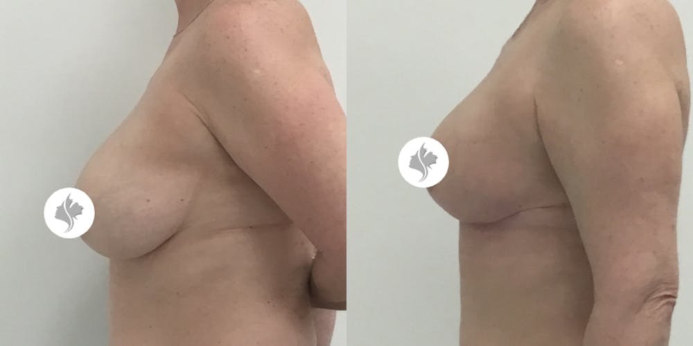 This is one of our beautiful breast asymmetry correction patient #13