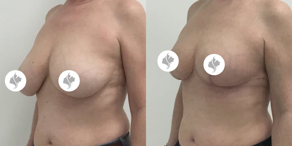 This is one of our beautiful breast asymmetry correction patient #13