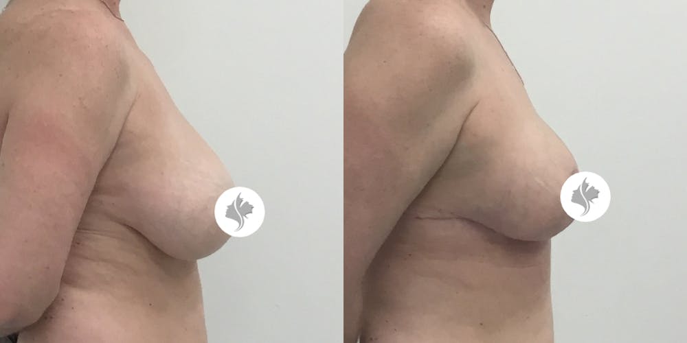 This is one of our beautiful breast asymmetry correction patient #13