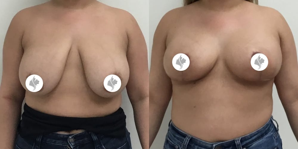 This is one of our beautiful breast reduction patient #48