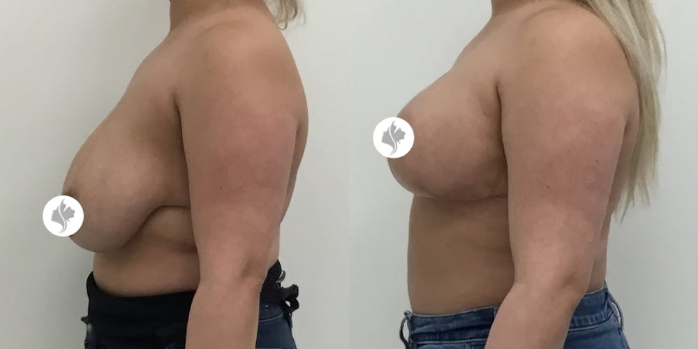 This is one of our beautiful breast reduction patient #48