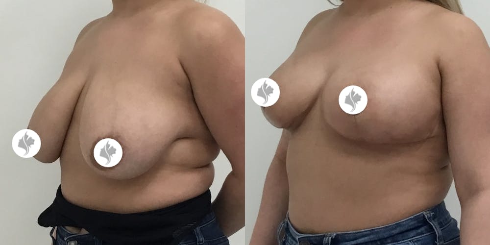 This is one of our beautiful breast reduction patient #48