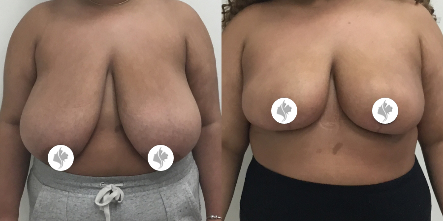 This is one of our beautiful breast reduction patient 49