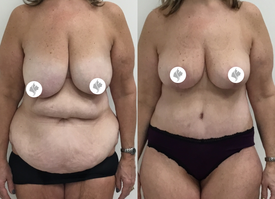 This is one of our beautiful post-bariatric body contouring patient 15