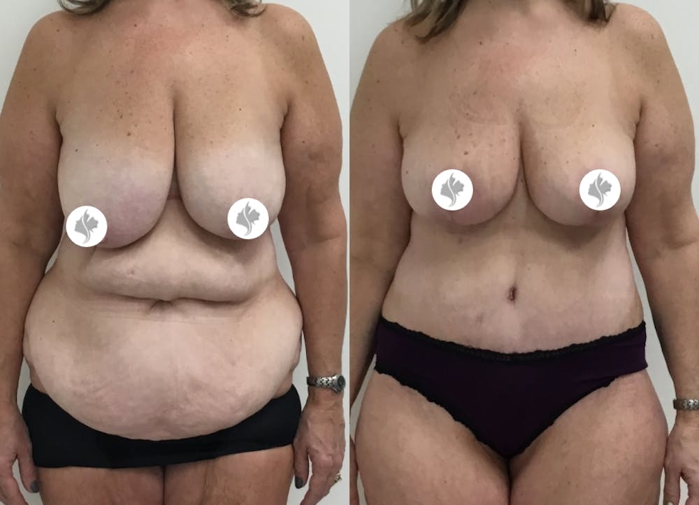 This is one of our beautiful post-bariatric body contouring patient #15