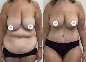 This is one of our beautiful mommy makeover patient 16