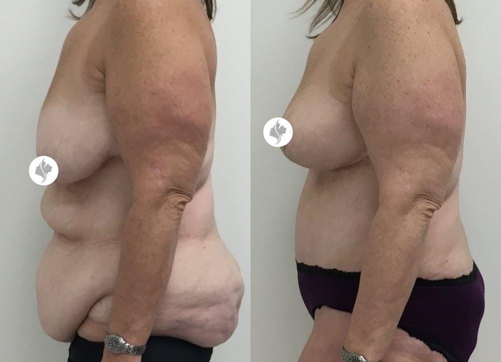 This is one of our beautiful post-bariatric body contouring patient #15