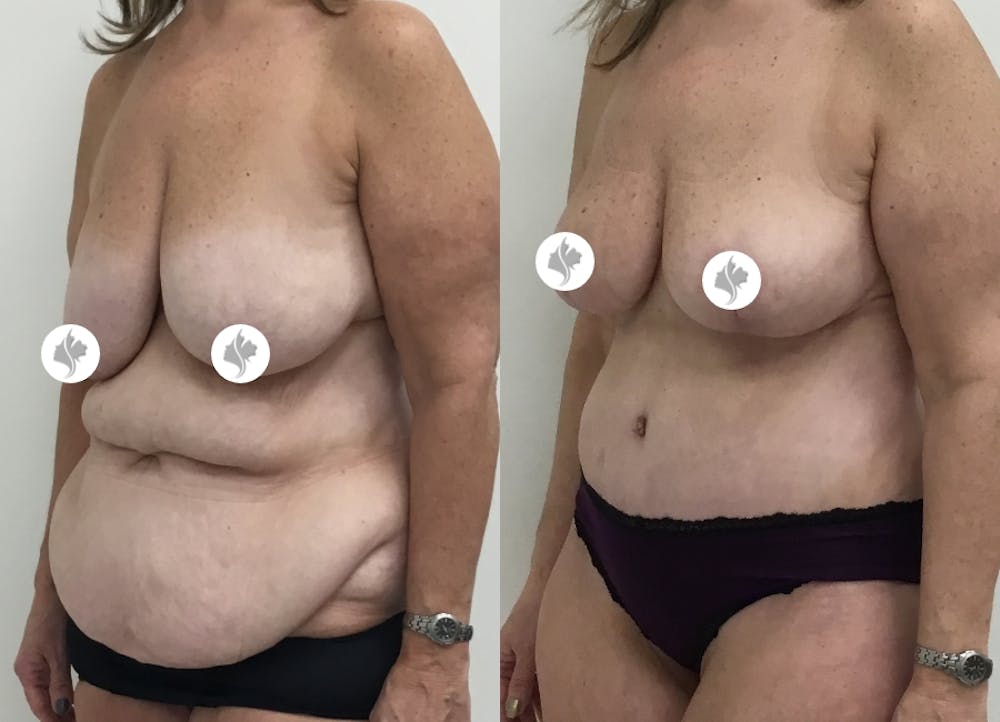 This is one of our beautiful post-bariatric body contouring patient #15