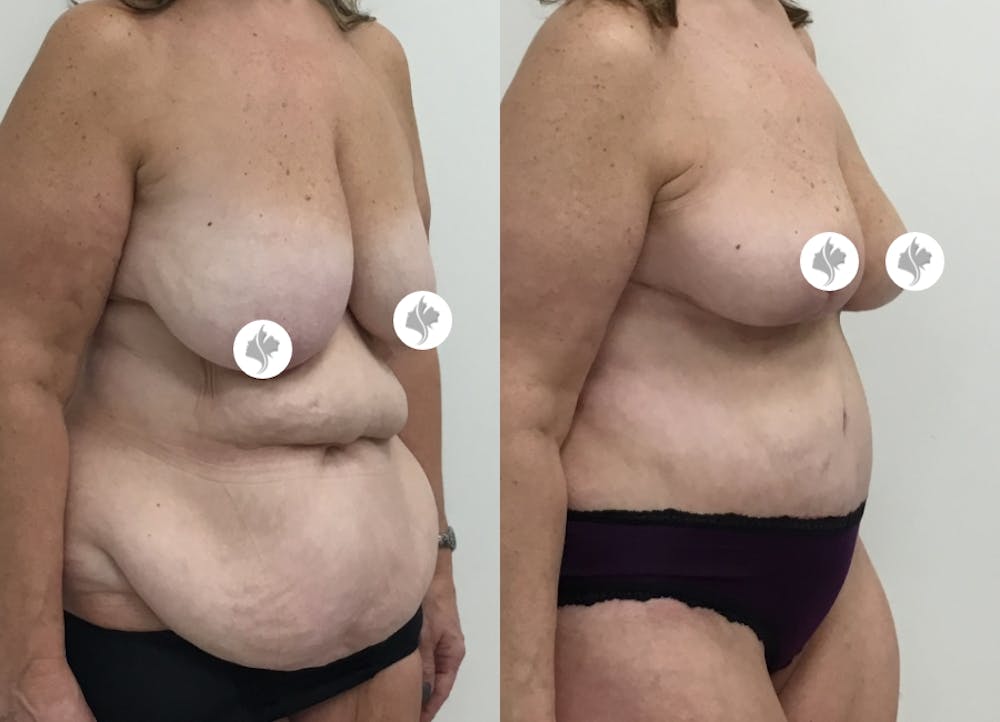 This is one of our beautiful post-bariatric body contouring patient #15