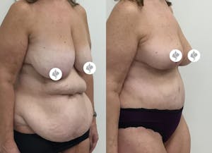 This is one of our beautiful mommy makeover patient 16