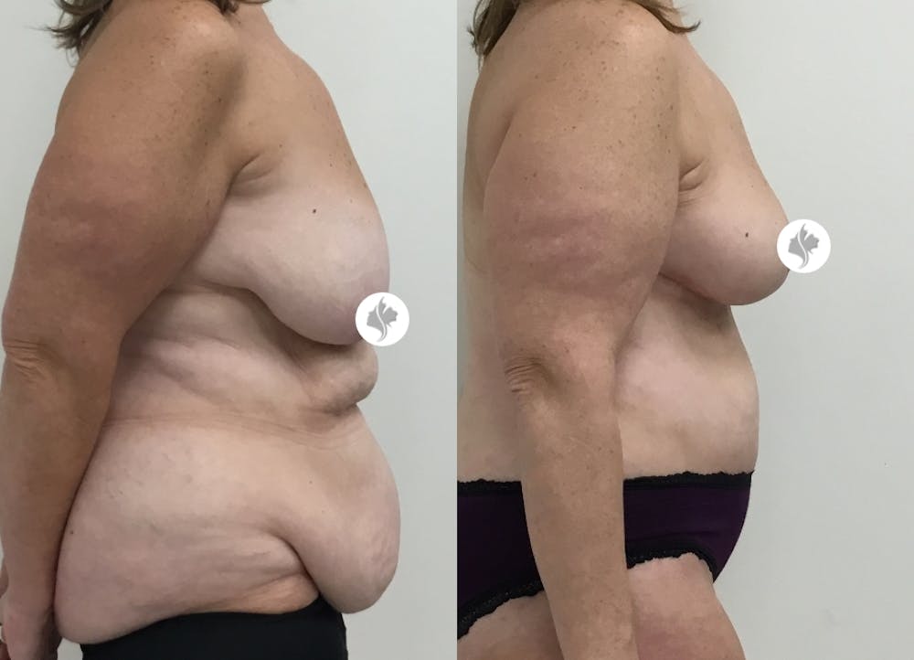 This is one of our beautiful post-bariatric body contouring patient #15