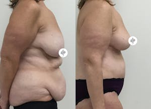 This is one of our beautiful tummy tuck patient 17