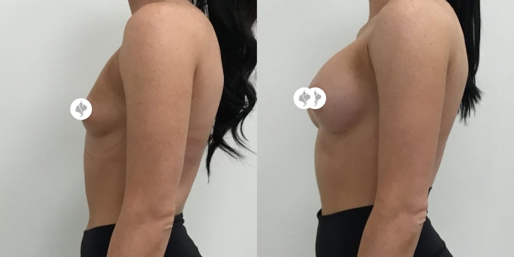 This is one of our beautiful breast augmentation patient #15