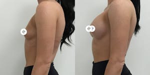 This is one of our beautiful breast augmentation patient 15
