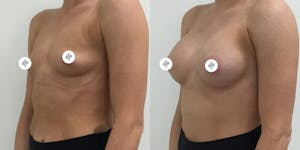 This is one of our beautiful breast augmentation patient 15