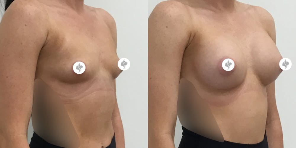 This is one of our beautiful breast augmentation patient #15