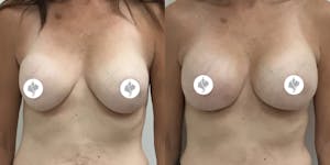 This is one of our beautiful breast augmentation patient 16