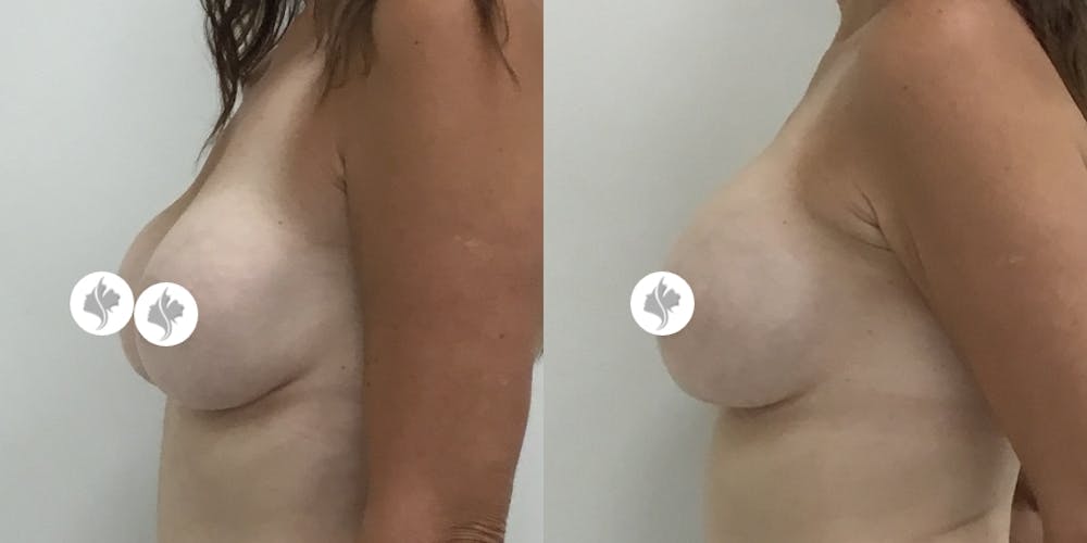 This is one of our beautiful breast augmentation patient #16