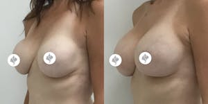 This is one of our beautiful breast implant revision patient 2
