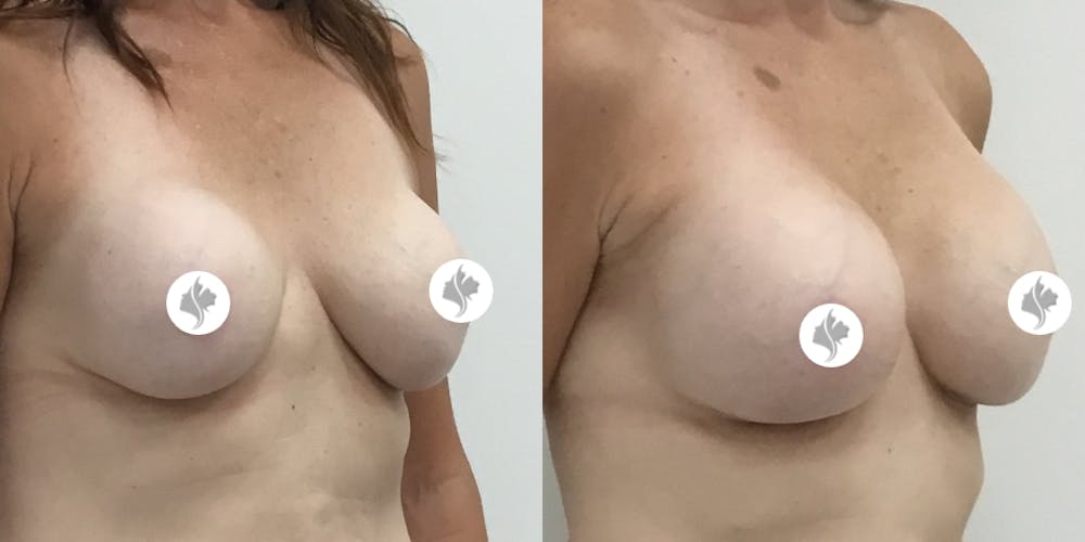 This is one of our beautiful breast augmentation patient #16