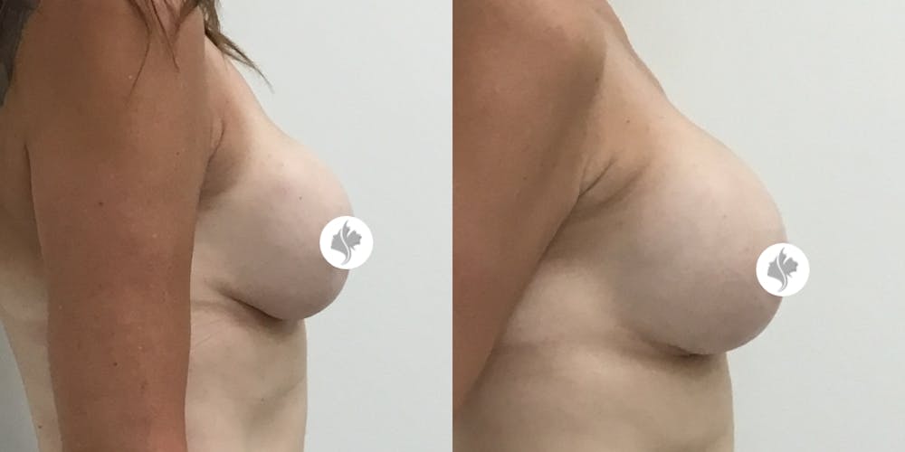 This is one of our beautiful breast augmentation patient #16