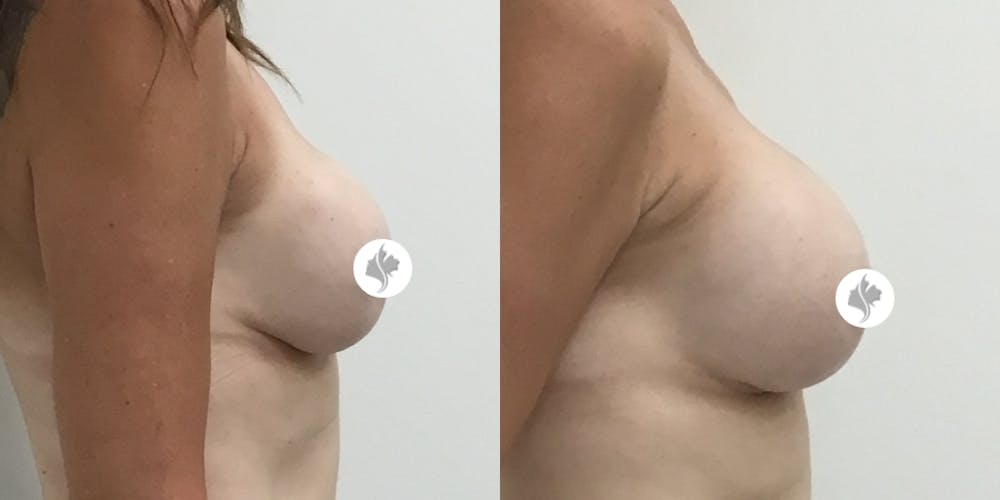 This is one of our beautiful breast implant revision patient #2