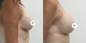 This is one of our beautiful breast implant revision patient 2