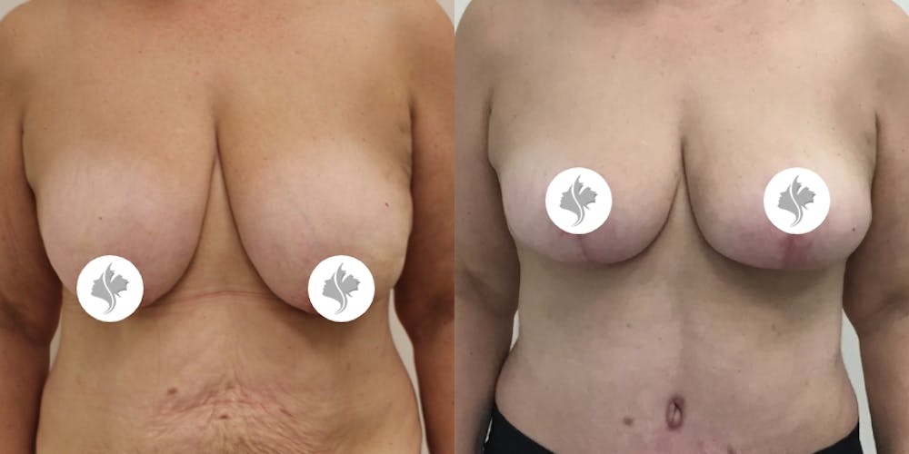 This is one of our beautiful breast reduction patient #4