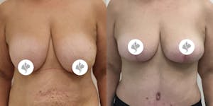 This is one of our beautiful breast reduction patient 4