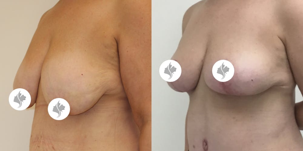 This is one of our beautiful breast reduction patient #4