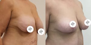 This is one of our beautiful breast reduction patient 4