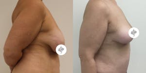 This is one of our beautiful breast reduction patient 4