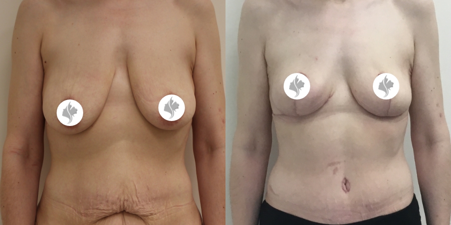 This is one of our beautiful breast reduction patient 50