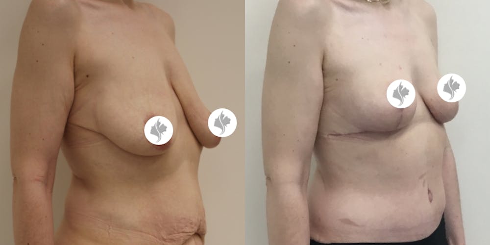 This is one of our beautiful breast reduction patient #50