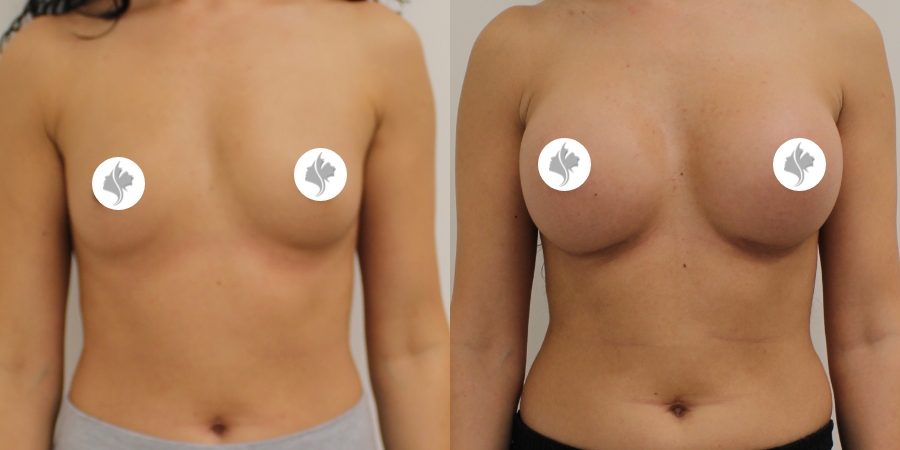 This is one of our beautiful breast augmentation patient 17