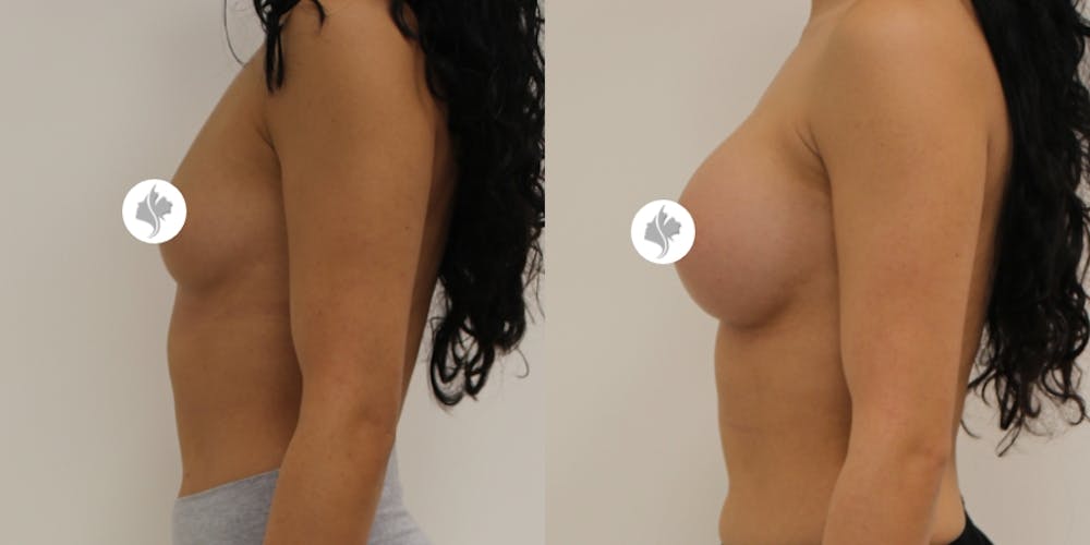 This is one of our beautiful breast augmentation patient #17