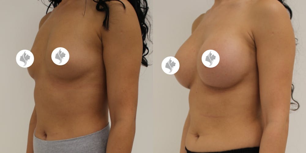 This is one of our beautiful breast augmentation patient #17