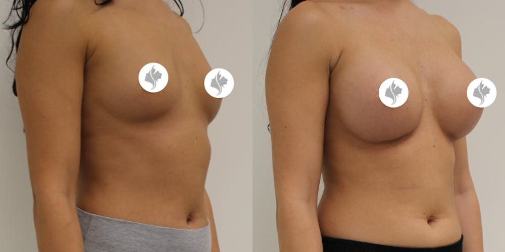 This is one of our beautiful breast augmentation patient #17