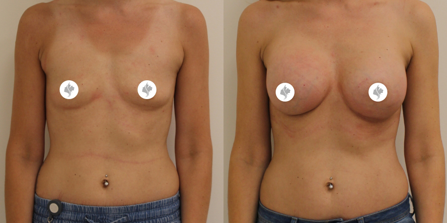 This is one of our beautiful breast augmentation patient 18