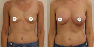 This is one of our beautiful breast augmentation patient 18