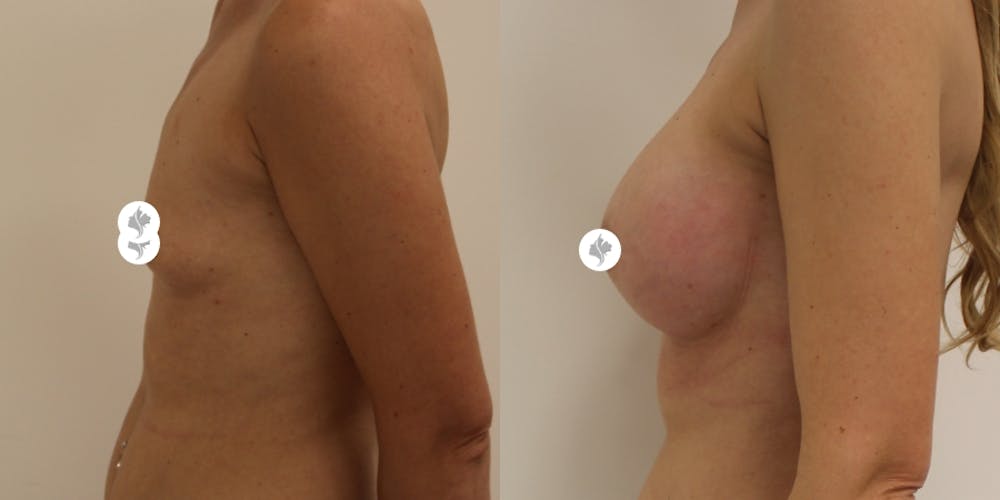 This is one of our beautiful breast augmentation patient #18