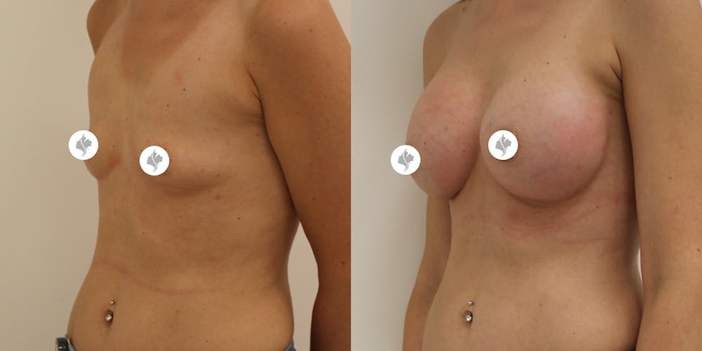 This is one of our beautiful breast augmentation patient #18