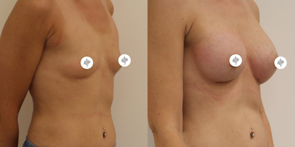 This is one of our beautiful breast augmentation patient #18