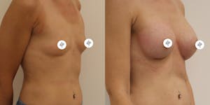 This is one of our beautiful breast augmentation patient 18
